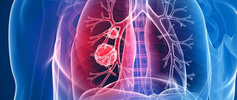 El cáncer de pulmón no solo es consecuencia del tabaquismo. (Shutterstock)