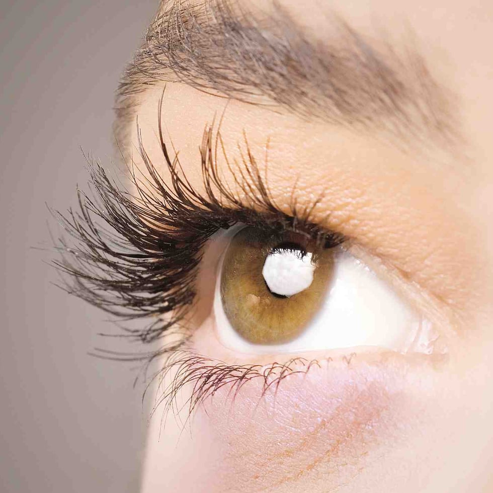 La sequedad ocular es un efecto adverso frecuente de la cirugía ocular Lasik, que puede prolongarse durante meses o incluso años después de la operación.