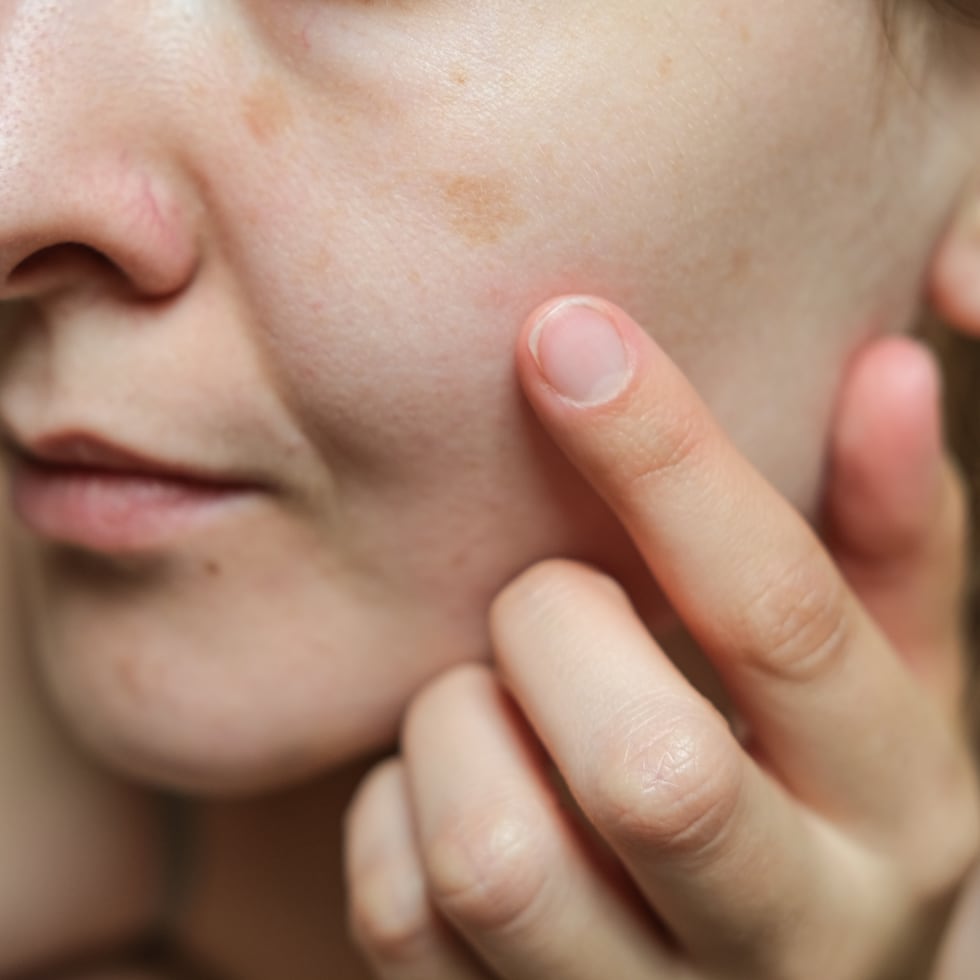 En dermatología existe un principio sencillo: es preferible evaluar diez manchas benignas que pasar por alto una lesión importante.