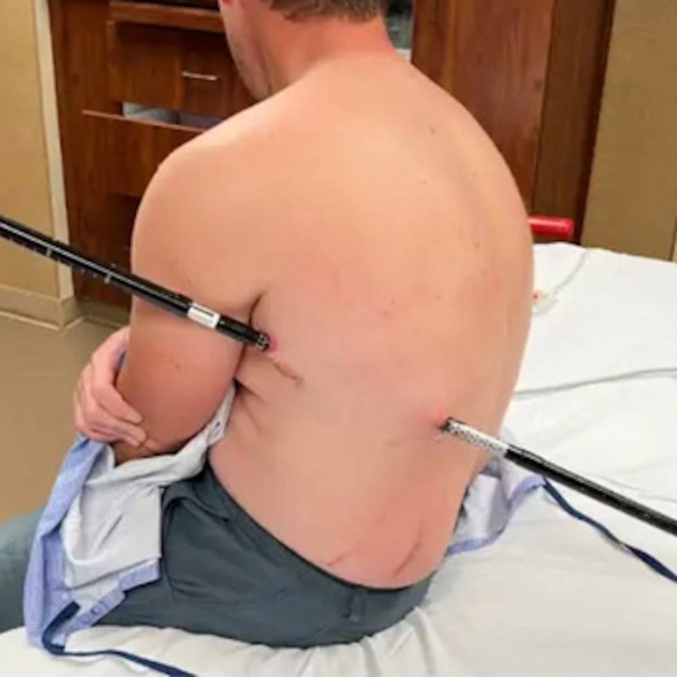 Esta fotografía, facilitada por David Cifaldi, muestra a Cifaldi mientras recibía tratamiento el lunes en el Hospital Regional St. Vincent de Billings, Montana.