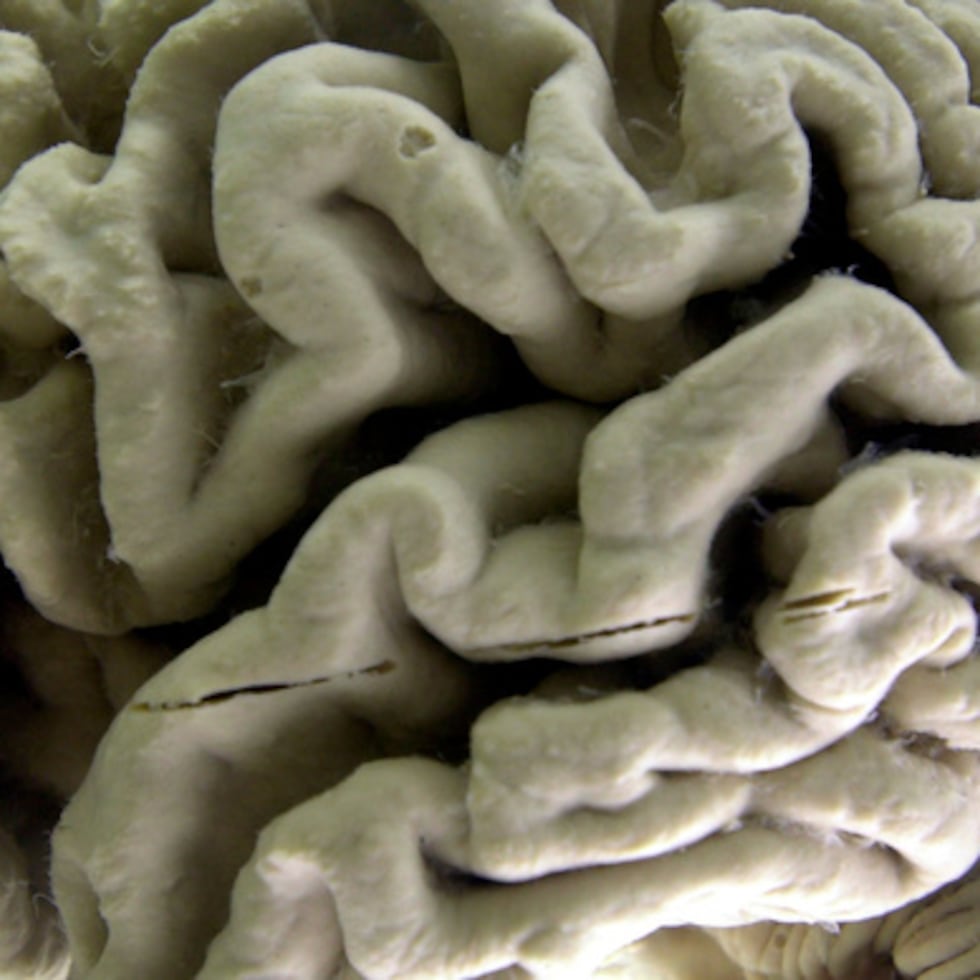 ARCHIVO - Un cerebro humano afectado por la enfermedad de Alzheimer se expone en el Museo de Neuroanatomía de la Universidad de Buffalo, en Buffalo (Nueva York), el 7 de octubre de 2003. (Foto AP/David Duprey, archivo)