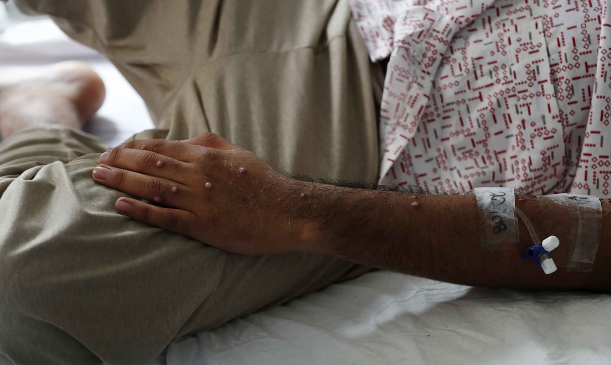 Salud reporta primeros casos de mpox cepa clado I en Puerto Rico