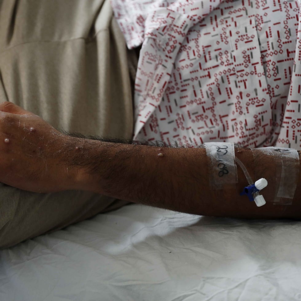 La viruela símica es una enfermedad viral poco común que se transmite por contacto cercano piel con piel, transmisión sexual y puede incluir síntomas como dolor de cabeza, fiebre, dolor muscular y erupciones en la piel.
