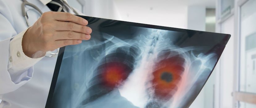Los expertos han advertido de la importancia de conocer previamente si un tumor va a ser o no sensible a la inmunoterapia, considerando que los fármacos no están exentos de efectos secundarios y que son caros. (Shutterstock)
