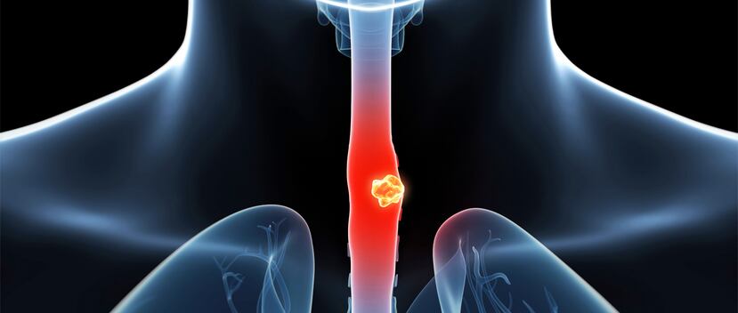 Aunque no todos los cánceres del esófago pueden ser prevenidos, el riesgo de desarrollarlo puede reducirse, teniendo en cuenta lo que ya conocemos de la enfermedad. (Shutterstock)