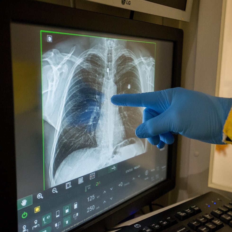 Para 2024, se estimaba que el 5.8% de los adultos en Puerto Rico padecía de enfermedad pulmonar obstructiva crónica, una condición crónica.