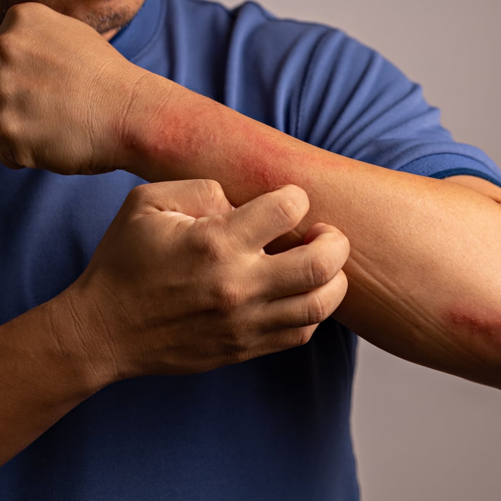 No todas las personas con psoriasis reaccionan igual. Algunas pueden notar mejoría con mayor exposición solar moderada, mientras otras pueden presentar irritación con el calor.