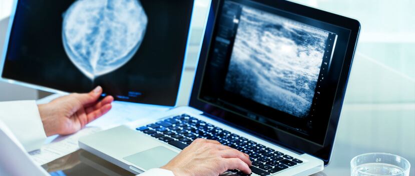 Hasta ahora se sabía que el cáncer de mama triple negativo se debe a numerosas mutaciones que actúan conjuntamente. (Shutterstock)