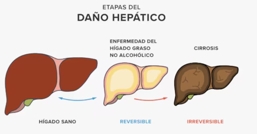 Etapas del daño heoático.