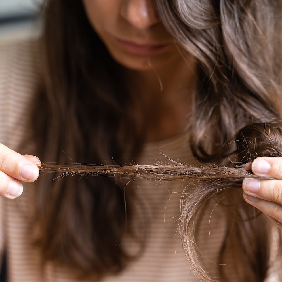 La alopecia en mujeres es muy común y suele avanzar de manera más difusa y menos visible en sus etapas iniciales.