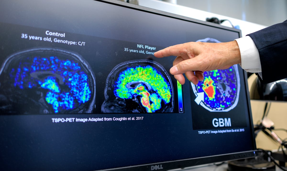 Alzheimer antes de los síntomas: la detección y el tratamiento temprano