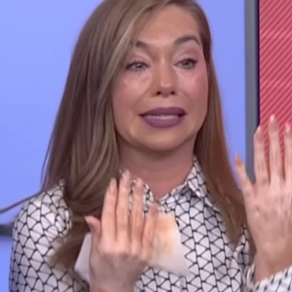 Entre lágrimas, la meteoróloga Pinky Lilian Pérez de Telemundo 60 mostró la pérdida de color de sus manos.