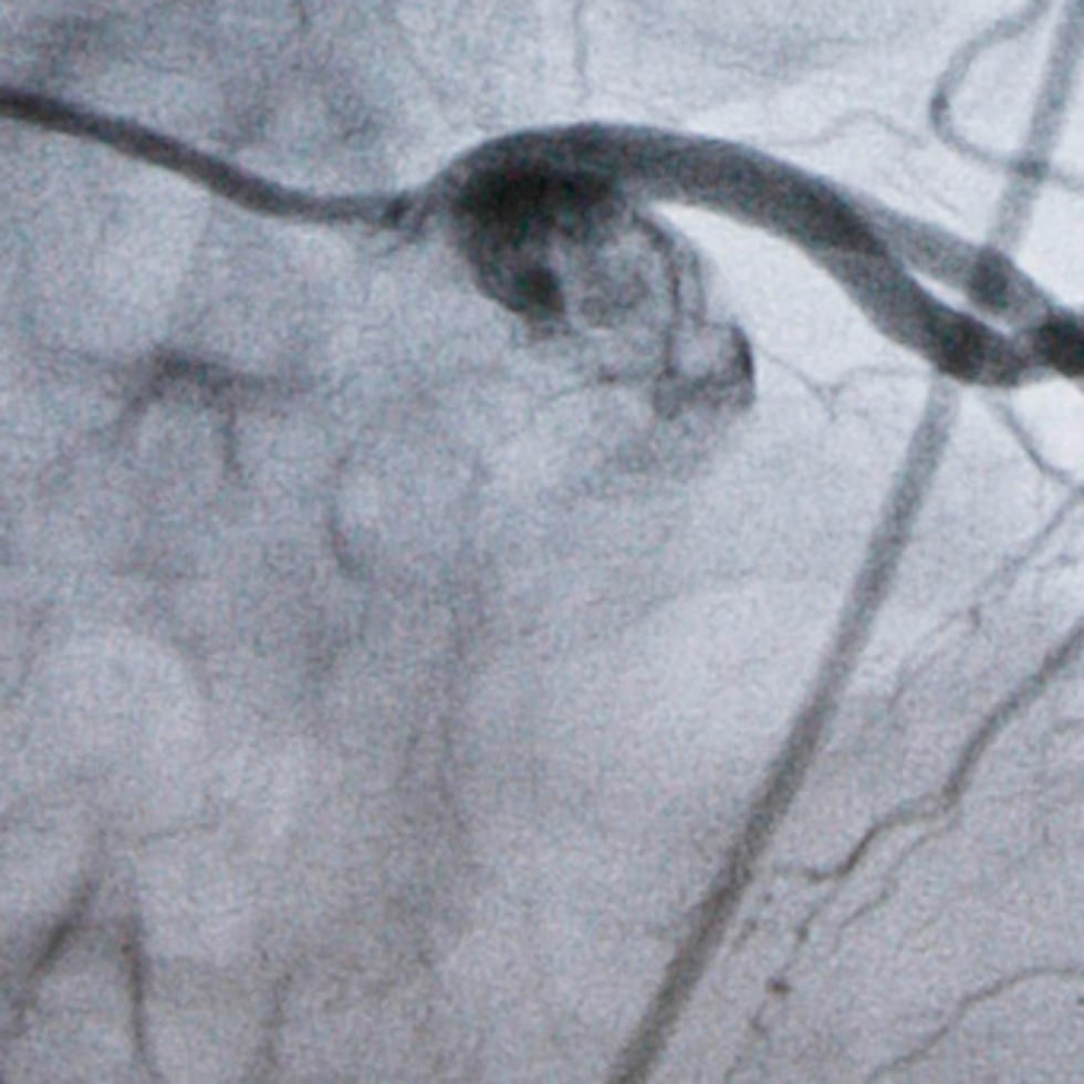 Un monitor muestra una arteria durante un procedimiento cardiaco en un laboratorio de cateterismo en Burlington, Vermont.