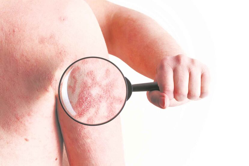 La psoriasis es una condición del sistema inmunológico caracterizada por la proliferación anormal de las células cutáneas. (Archivo/ GFR Media)