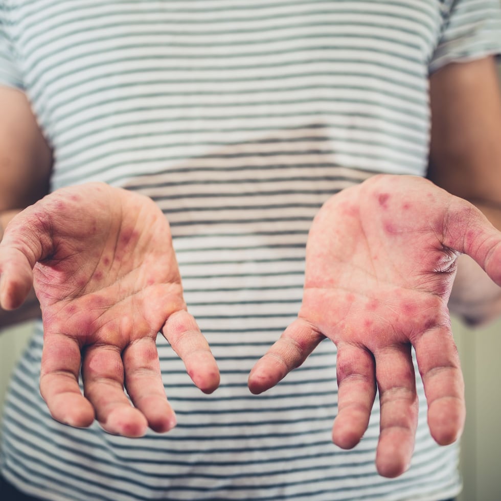 El sarampión causa sarpullido, entre otros síntomas que pueden ser difíciles de diagnosticar.