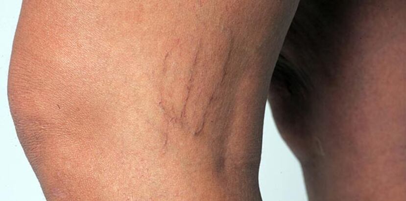 Las várices son la consecuencia de sistemas valvulares disfuncionales, es decir, que no están operando como corresponden. (Archivo)