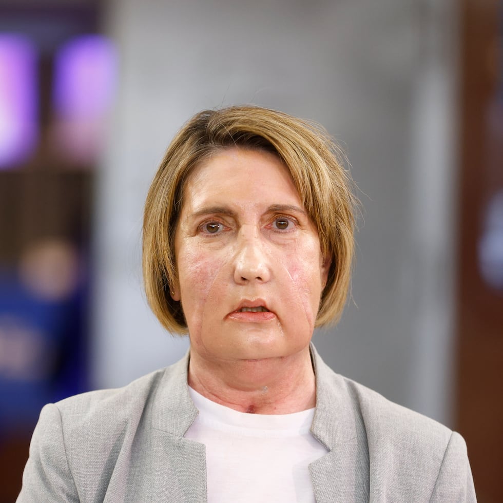 Carmen, la primera paciente en recibir un trasplante de cara de una donante que recibió una eutanasia, posa para los medios de comunicación antes de la rueda de prensa que se ha celebrado en el Hospital Vall d'Hebron de Barcelona para explicar el procedimiento. EFE/Quique García