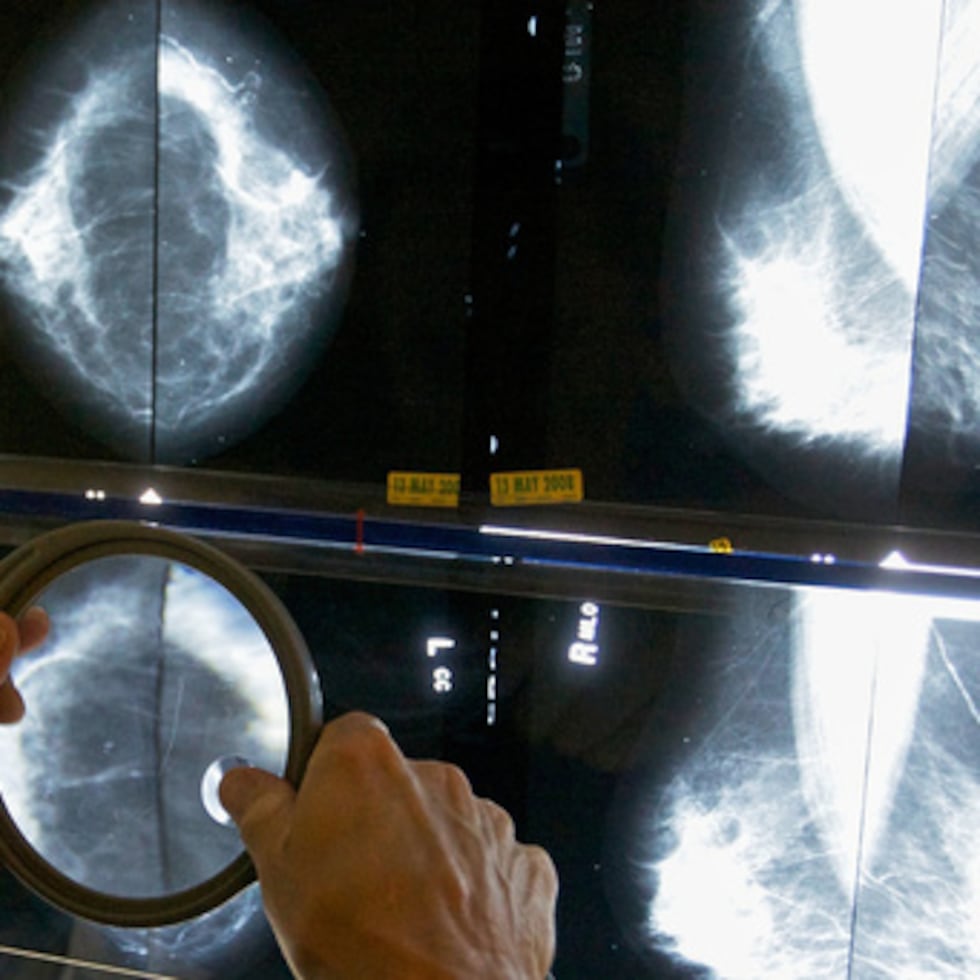 ARCHIVO - Un radiólogo utiliza una lupa para examinar mamografías de cáncer de mama en Los Ángeles, 6 de mayo de 2010. (AP Photo/Damian Dovarganes, Archivo)