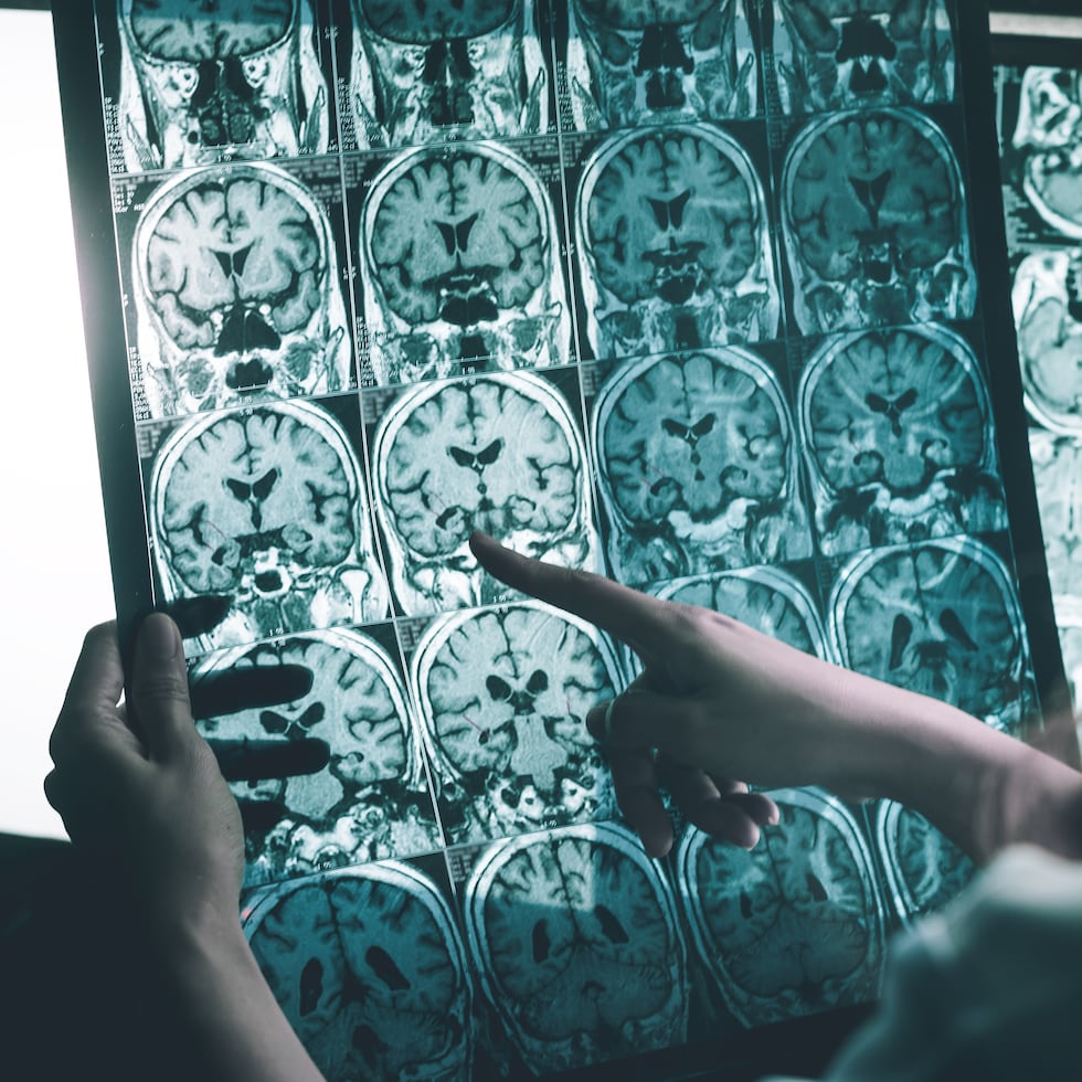 Los autores consideran fundamental que este trabajo pueda ayudar a diseñar ensayos clínicos futuros que prueben intervenciones con ejercicio para ralentizar el deterioro cognitivo en la vejez, especialmente en personas con un riesgo elevado de desarrollar la enfermedad de Alzheimer.