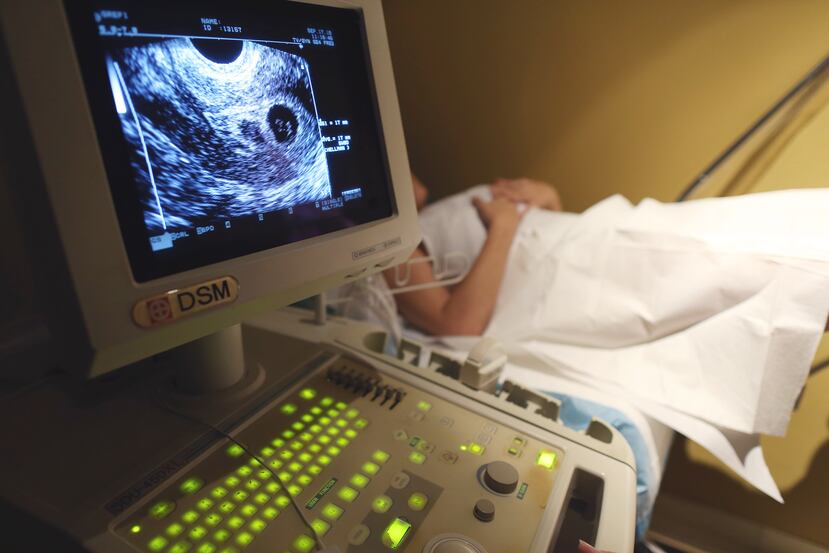 Sonograma de una paciente que se sometió a fertilización in vitro.