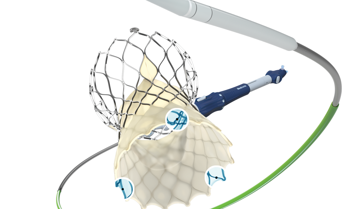 Revolutionaria tecnología de Medtronic para combatir la estenosis aórtica severa