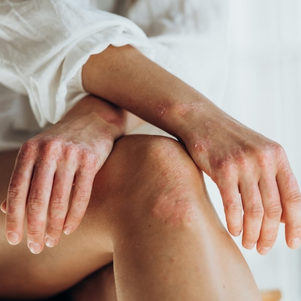 La artritis psoriásica es una enfermedad crónica autoinmune incurable que combina el dolor e inflamación de las articulaciones, los tendones y ligamentos propias de la artritis con las manchas rojizas y escamosas que ocasionan picazón en la piel y el cuero cabelludo de la psoriasis.