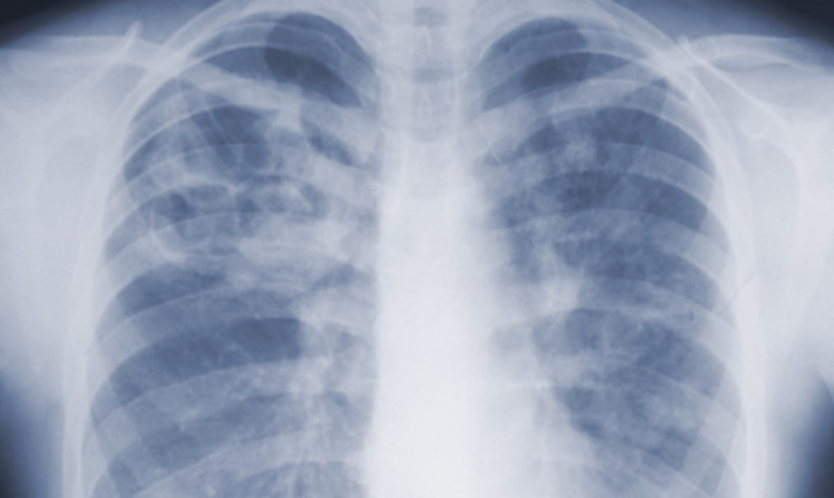 Estudio revela que infecciones invasivas por moho son una amenaza subestimada para la salud