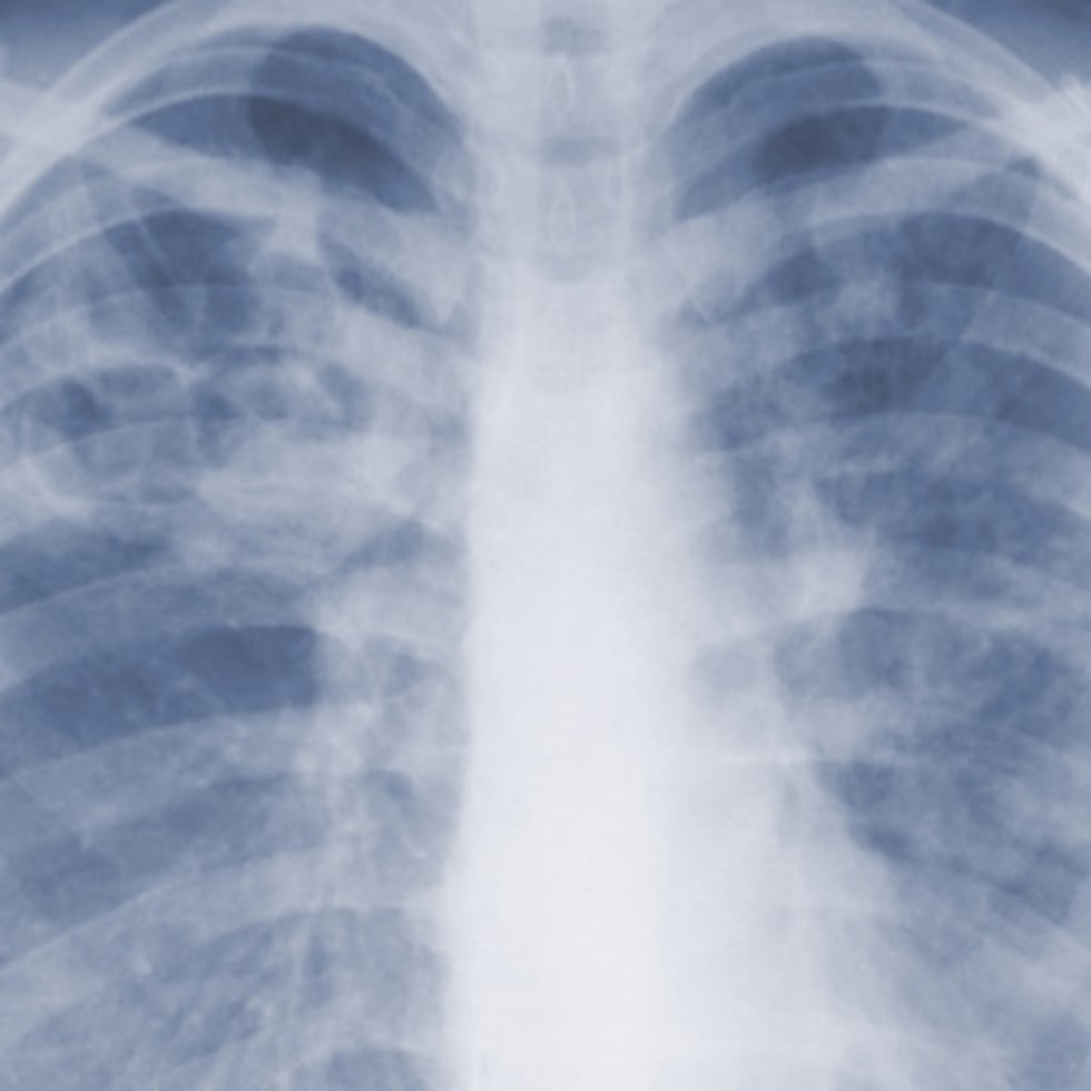 Esta radiografía de tórax de 1967, facilitada por los Centros para el Control y la Prevención de Enfermedades, muestra una aspergilosis pulmonar causada por un hongo del género Aspergillus.