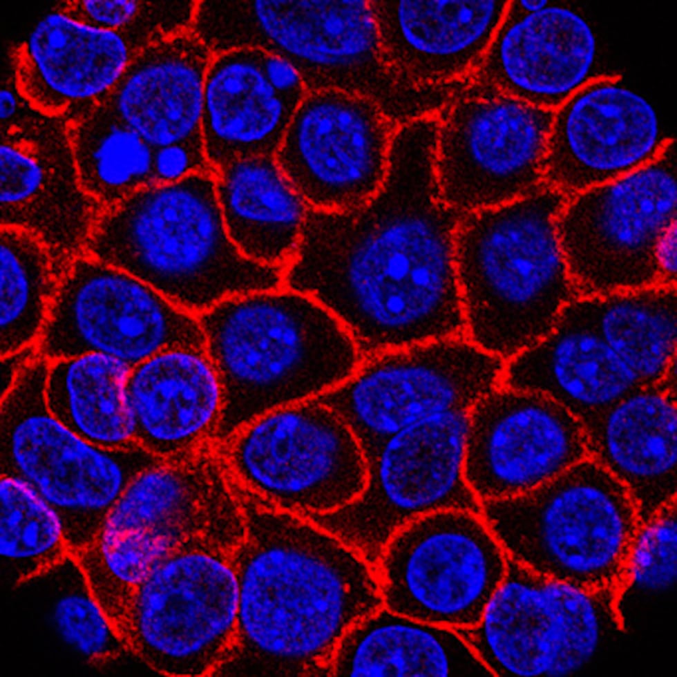 El fármaco se llama daraxonrasib y bloquea una proteína mutada que impulsa el crecimiento tumoral en más del 90% de los casos de cáncer de páncreas.