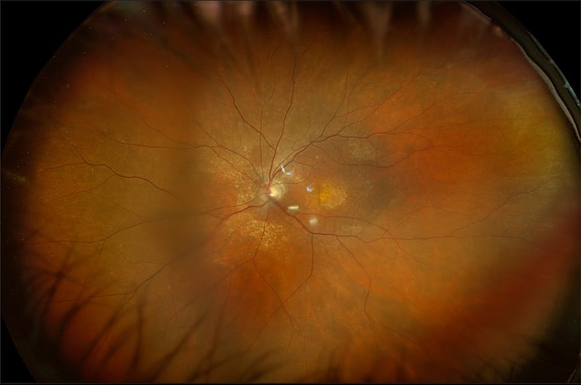 El descenso progresivo de los niveles de estrógenos no solo repercute en distintos órganos y tejidos del cuerpo, sino que también puede alterar la superficie ocular, la producción lagrimal y otras estructuras del ojo. Miranza.