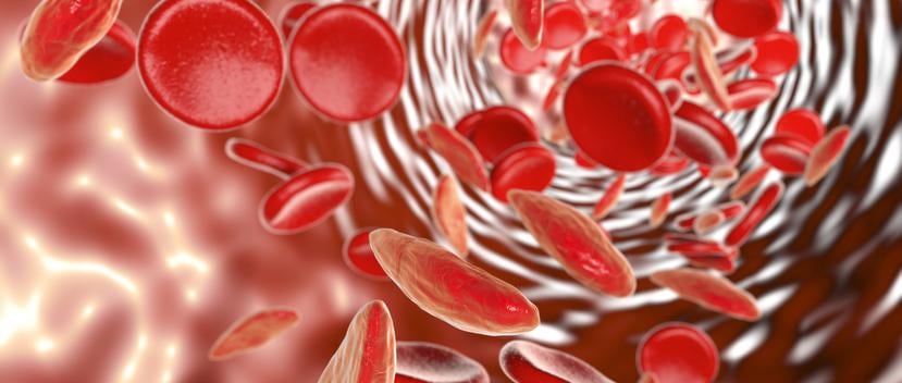La anemia falciforme es un trastorno hereditario de la sangre en el que los glóbulos rojos tienen una forma anormal. (Shutterstock)