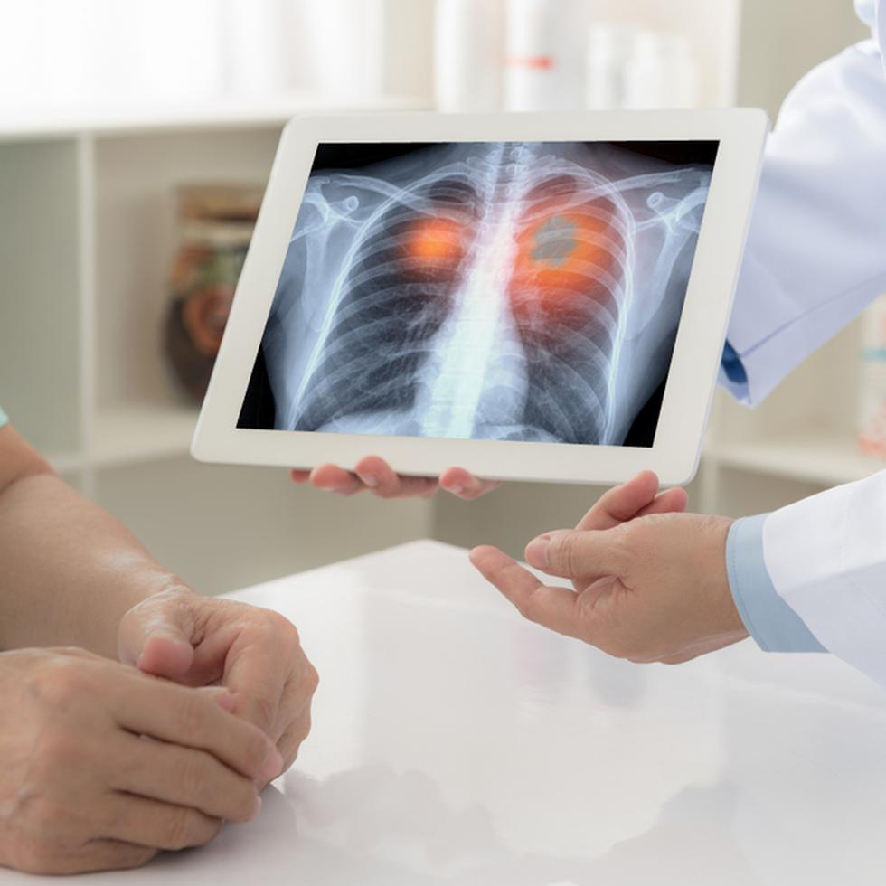 La prueba de detección del cáncer de pulmón se recomienda solo a los adultos que tienen un riesgo alto de tener la enfermedad debido a sus antecedentes de tabaquismo y a la edad.