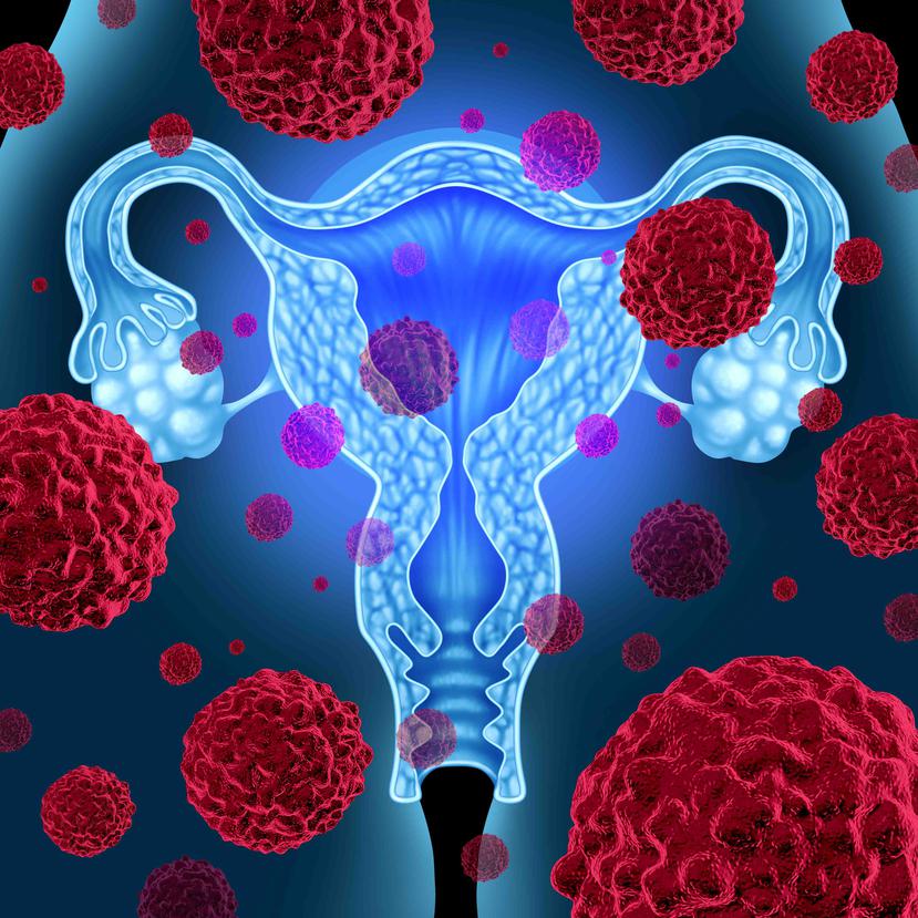Cuando una mujer presenta síntomas sospechosos, se ordenan ciertas pruebas de sangre y estudios radiológicos que puedan demonstrar cambios asociados con un cáncer de ovario. (Foto: Shutterstock.com)