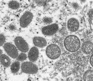 Esta viruela se considera endémica en lugares como Nigeria y la República del Congo y es conocido como “viruela de mono” o “monkeypox”.