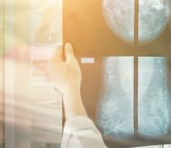 La mamografía es el mejor estudio para detectar las microcalcificaciones, que son la forma más temprana en la que se puede ver el cáncer de seno. (Shutterstock)