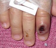 Foto de archivo del Centro Estadounidense de Control de las Enfermedades (CDC) en la que se aprecia el dedo de un niño infectado por la viruela de mono.
