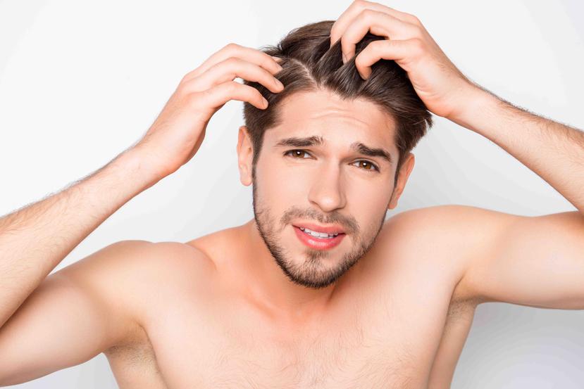 Cuando se tiene caspa, se puede sentir picazón y el cuero cabelludo y el cabello pueden tener un aspecto grasoso. (Shutterstock)