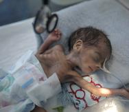 Niño yace en el hospital Al-Sabeen en Yemen. (AP)