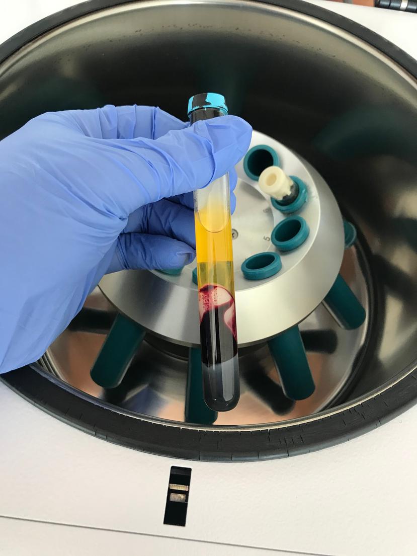 El PRP consiste en extraer la sangre a un paciente, se centrifuga para separarla en sus diferentes fases o componentes. 
