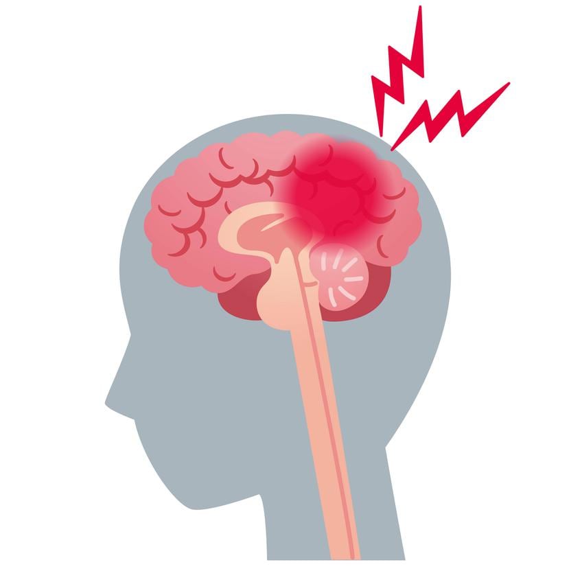 Hay dos tipos de derrame cerebral: el isquémico que es el más común (alrededor de un 85%) y el hemorrágico que no es tan común, pero tiene una mortalidad más alta. (Foto Shutterstock).